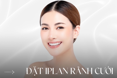Đặt implant rãnh cười